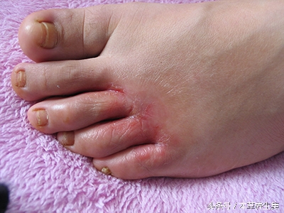 脚脱皮长水泡是哪种真菌感染,趾间糜烂型脚气穿过的鞋怎么处理