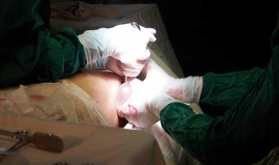 戴了二十多年环取出来是什么样的,上了20多年的环怎么取