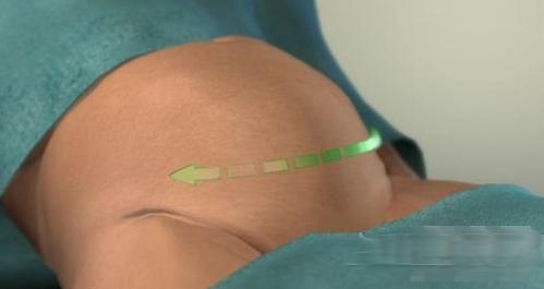 剖腹产女人不可逆的伤害,剖腹产请善待妈妈