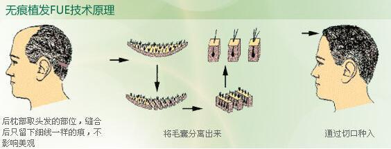 脱发植发青睐雍禾植发,深圳新生植发治疗脱发真的有效吗