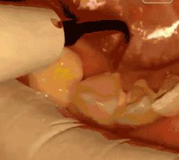 牙结石为什么用手抠不掉,自己抠牙结石能抠干净吗