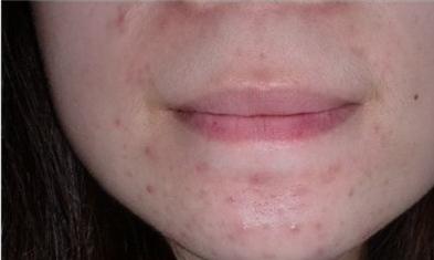 下巴长痘痘的图片和分析,下巴长痘老中医推荐