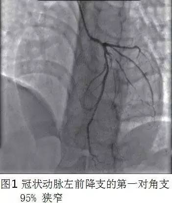 冠心病会长黄色瘤不,年轻人高发冠心病