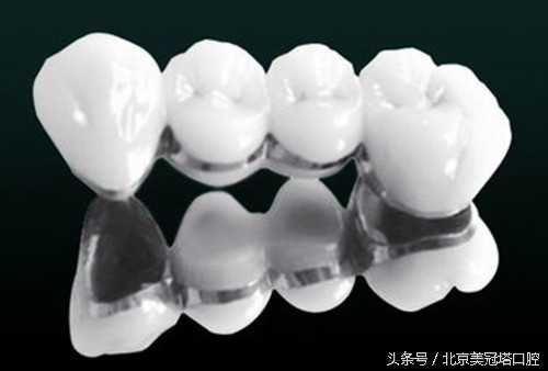 镶一口烤瓷牙到底好不好,镶的烤瓷牙有什么不习惯的吗