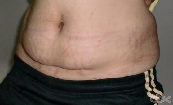 产后大肚腩肚皮松垮,产后十年的肚皮松垮还能恢复吗