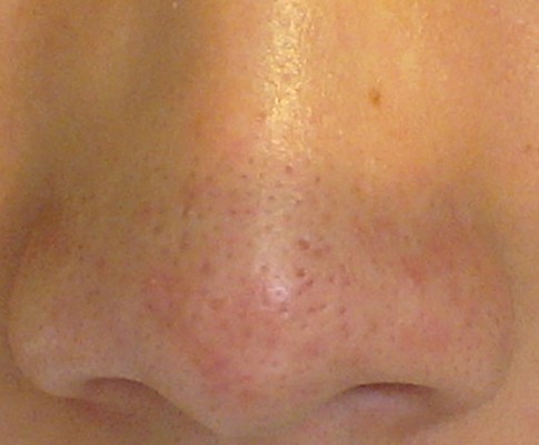 鼻子黑头毛孔粗大怎么收缩毛孔,鼻子毛孔粗大黑头怎么解决