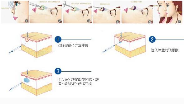 玻尿酸隆鼻的效果到底怎么样啊,玻尿酸隆鼻是不是适合每个人