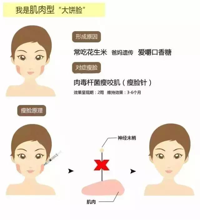 瘦脸针3d科普,科普瘦脸针打三次真的能定型吗