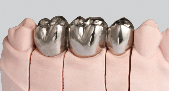 哪种镶牙材料价格又便宜又好,镶牙哪种材料最好