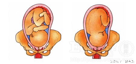 分娩过程中最常见的胎位,分娩中最常见胎位