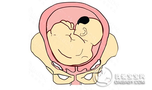 胎位不正怎么办？导致胎位不正的原因是什么？
