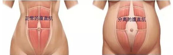 产后大肚腩肚皮松垮,产后十年的肚皮松垮还能恢复吗