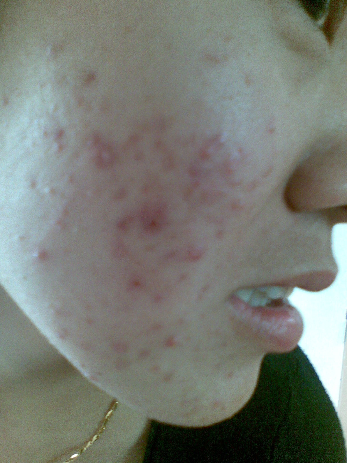 油脂痘该怎么解决,满脸痘怎么调理