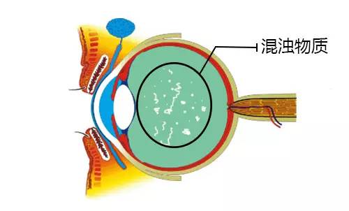 眼睛看东西有蚊子飞是怎么回事,眼前有蚊子飞的影子啥原因