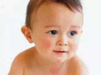 婴儿患湿疹怎么治疗,为什么普遍婴儿都得湿疹