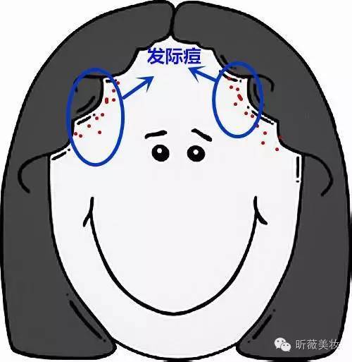 长痘不止青春期全年龄战痘,健康长痘不止青春期全年龄战痘