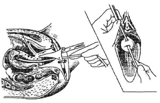药流后做人流,药流与人流用药
