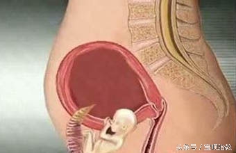 孕妈最怕的五件事,孕早期如何及早排查宫外孕