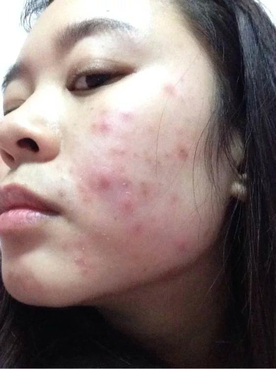 怎么修复痘痘皮肤,痘痘皮肤怎么调理