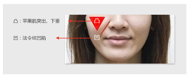 法令纹玻尿酸填充多久能洗脸化妆,法令纹填充玻尿酸会越填越深吗