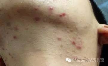 痘痘的形成和原因大全,痘痘的形成的原因分析