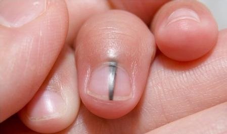 孙红雷黑色素瘤片段,孙红雷黑痣长在什么位置