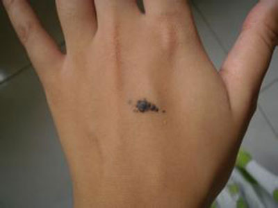 孙红雷黑色素瘤片段,孙红雷黑痣长在什么位置