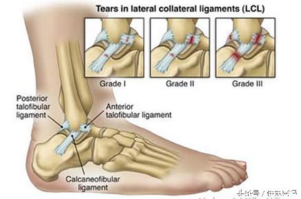 脚踝扭伤了不能走路怎么恢复最快,脚踝扭伤影响运动功能吗