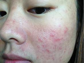 怎么修复痘痘皮肤,痘痘皮肤怎么调理