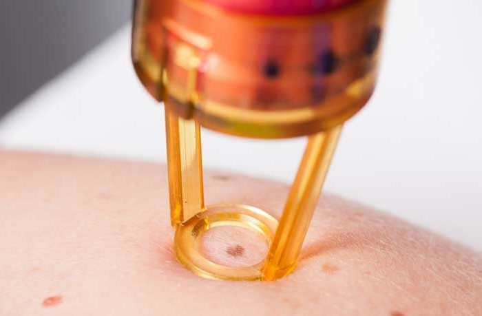 孙红雷黑色素瘤片段,孙红雷黑痣长在什么位置