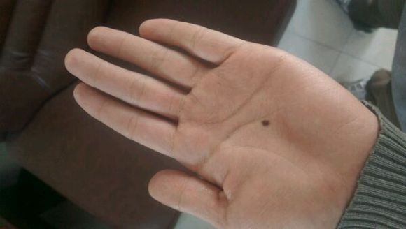 孙红雷黑色素瘤片段,孙红雷黑痣长在什么位置