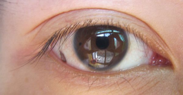 孙红雷黑色素瘤片段,孙红雷黑痣长在什么位置