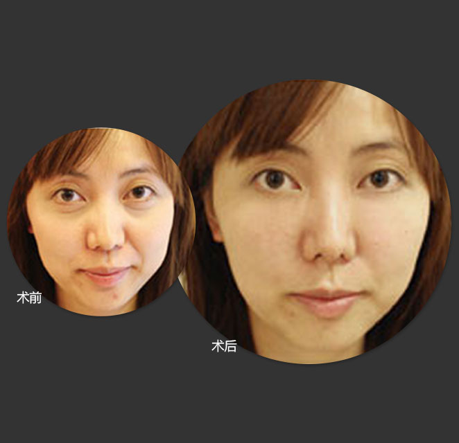 法令纹玻尿酸填充多久能洗脸化妆,法令纹填充玻尿酸会越填越深吗