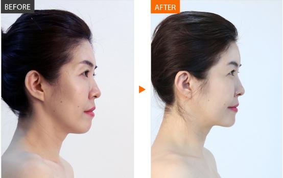 法令纹玻尿酸填充多久能洗脸化妆,法令纹填充玻尿酸会越填越深吗