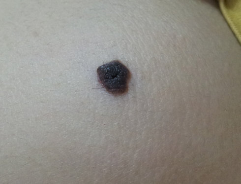 孙红雷黑色素瘤片段,孙红雷黑痣长在什么位置