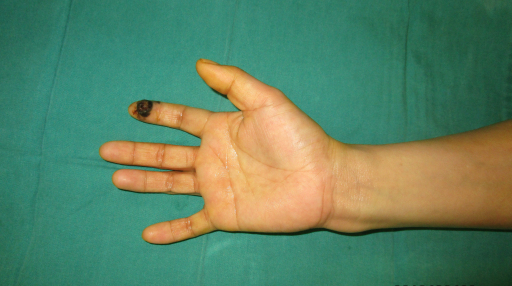 孙红雷黑色素瘤片段,孙红雷黑痣长在什么位置