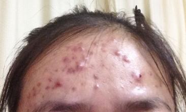 额头全是小米粒的痘痘怎么去掉,额头上有很多痘痘怎么办
