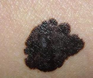 孙红雷黑色素瘤片段,孙红雷黑痣长在什么位置