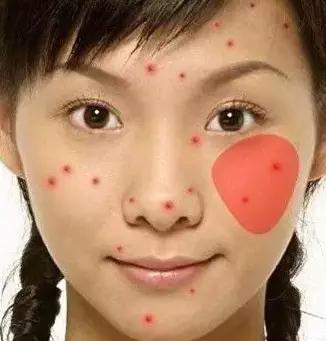 突然长很多痘是有什么病吗,3种长痘的原因了解一下你中了吗