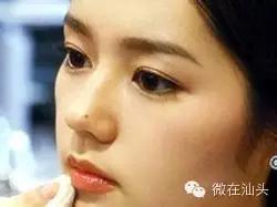 一图读懂什么样的痣易癌变,点痣后增生了肉痣会变癌吗