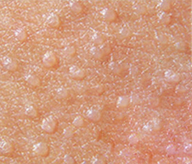 眼皮上长了一颗脂肪粒怎么去除,长在眼皮上的脂肪粒怎么去除