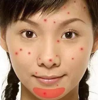 突然长很多痘是有什么病吗,3种长痘的原因了解一下你中了吗