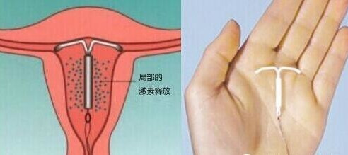 男人，如果你爱你的女人，就别让她上环！