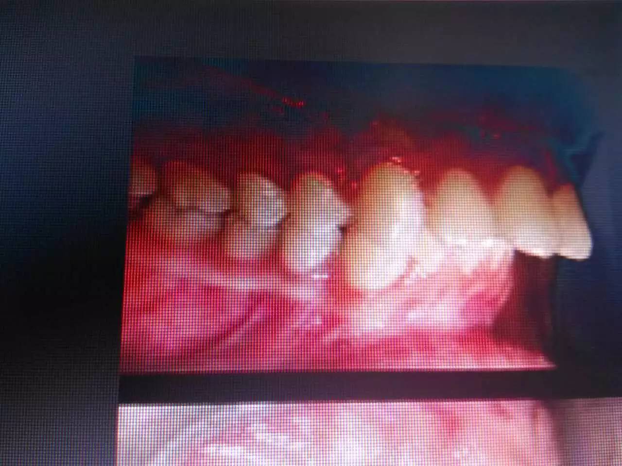 换牙注意事项以及禁忌,换牙期的十大禁忌