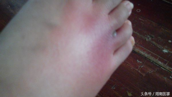 缝衣针扎了没出血会破伤风吗,缝针感染破伤风的概率