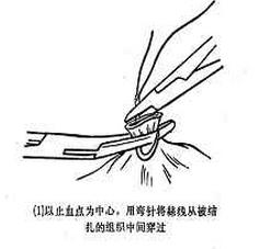 女性结扎恢复的手术过程,女性结扎的手术流程