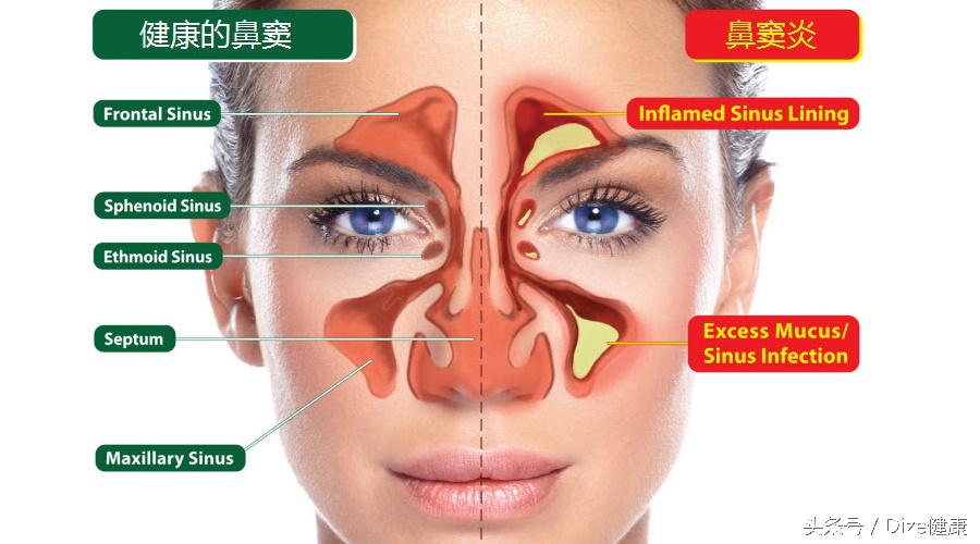 冬天不停流鼻涕鼻涕颜色还有点红,感冒一直流鼻涕原理