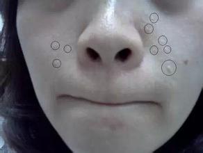 眼角有脂肪粒是如何形成的,怎么避免眼角长脂肪粒