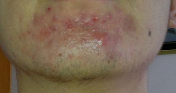 痘痘反反复复长的原因和应对方法,发际线两边痘痘反反复复一直冒痘