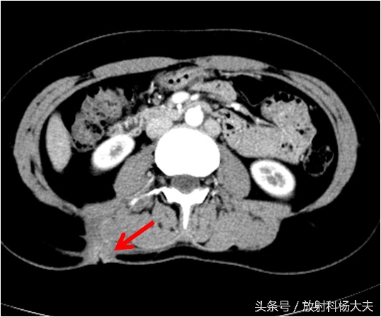 花季少女腰疼是什么原因,青春期女生为什么总是腿痛